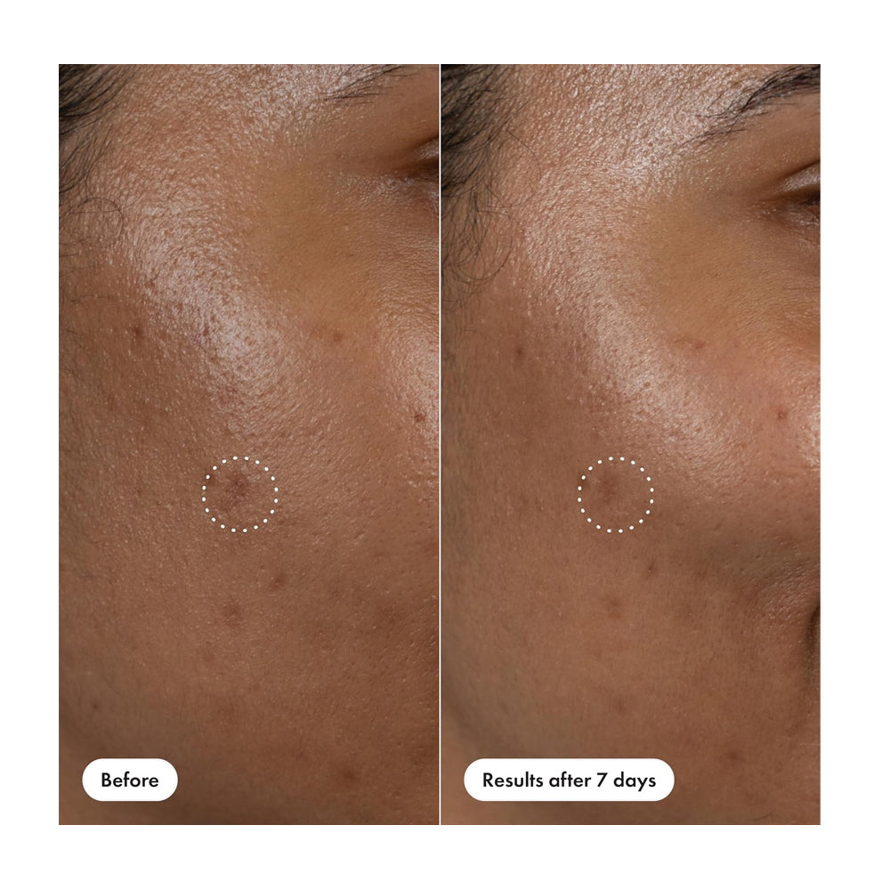 Hero Cosmetics Dark Spot Correct Spot-Fading Serum, Vitamin C, Hyaluronic Acid, For Acne-Prone Skin, 10ml