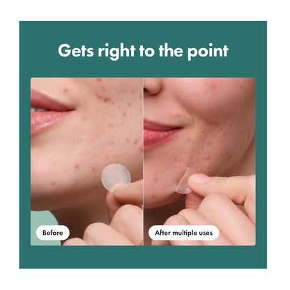 Hero Cosmetics Micropoint Pimple Patch  Salicylic Acid  Cica  For Acne-Prone Skin  8-Pack