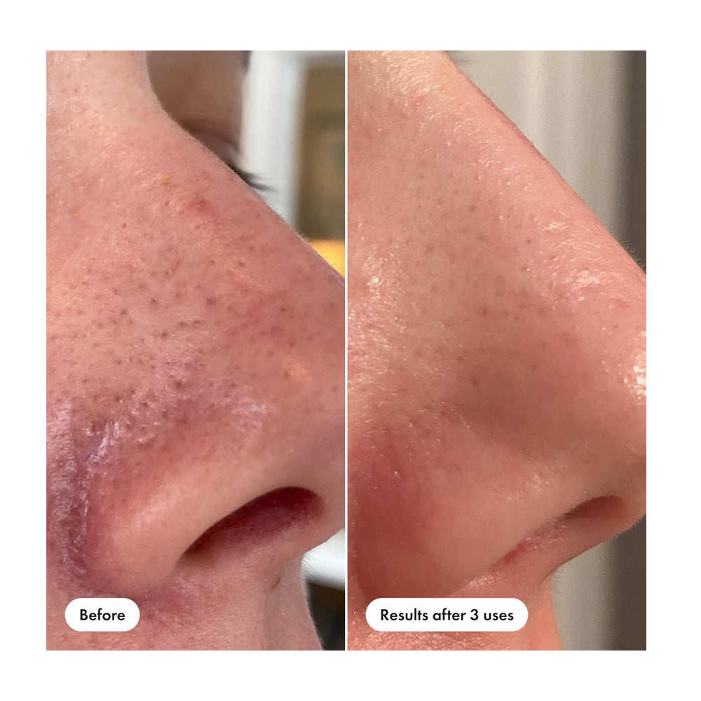 Hero Cosmetics Pore Release Blackhead Clearing Solution  Salicylic Acid  AHA & BHA  For Oily & Sensitive  100ml