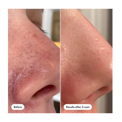 Hero Cosmetics Pore Release Blackhead Clearing Solution  Salicylic Acid  AHA & BHA  For Oily & Sensitive  100ml