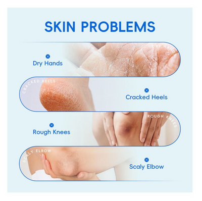 Laikou 40% Urea Cream, Salicylic Acid, Shea Butter, For Rough & Dry Skin, 100g, LK32883A